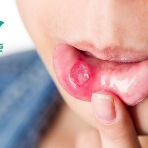 Bỏ túi bí quyết giúp thoát khỏi nhiệt khoang miệng đơn giản tại nhà Bỏ túi bí quyết giúp thoát khỏi nhiệt khoang miệng đơn giản tại nhà