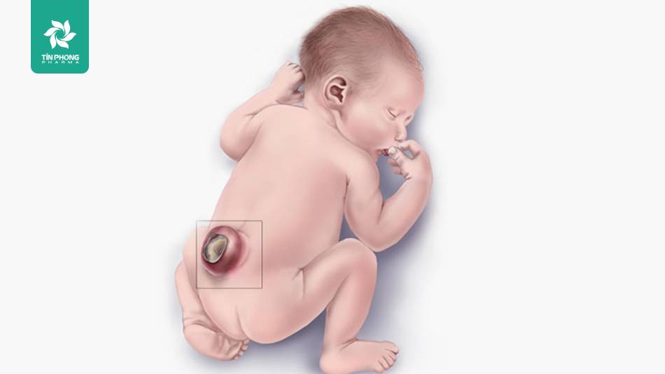 Dị tật ống thần kinh ở thai nhi là dị tật bẩm sinh nghiêm trọng của não và cột sống ở trẻ
