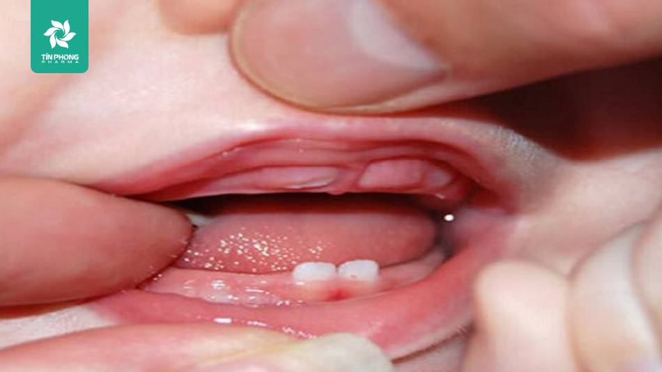 Trẻ sinh non có ảnh hưởng tới mọc răng?