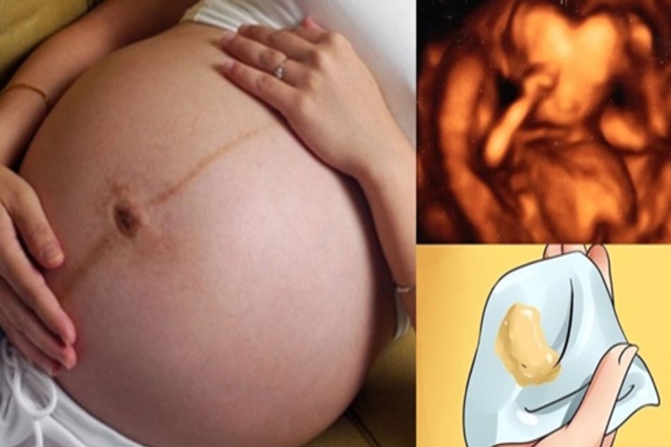 Viêm nhiễm âm đạo khi mang thai