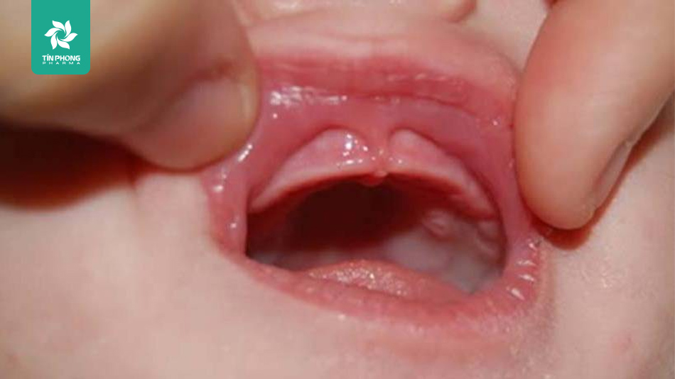 Dính thắng môi trên ở trẻ sơ sinh là gì?