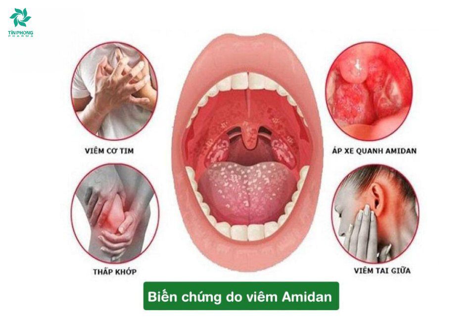 Nhận biết viêm amidan và điều trị viêm amidan đúng cách