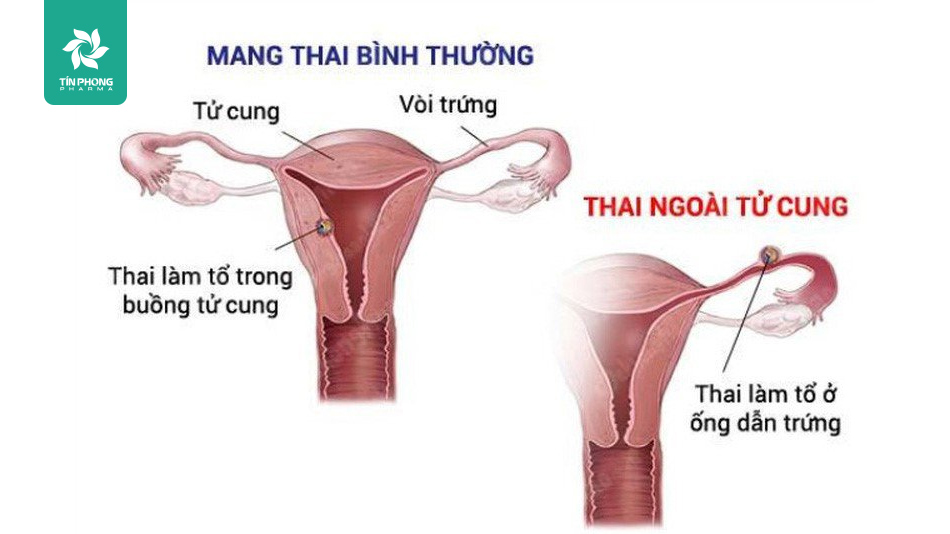 Thai ngoài tử cung là một trong những biến chứng thai sản có thể gặp