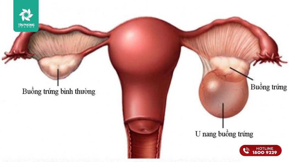 U nang buồng trứng có thể gây đau bụng như khi đến tháng