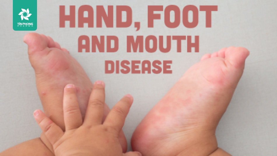 Mách bạn cách phát hiện bệnh tay chân miệng sớm nhất ở trẻ 