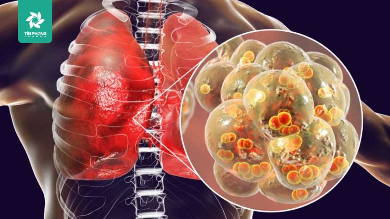 Viêm phổi ở trẻ em: Mọi khía cạnh cha mẹ cần nắm rõ