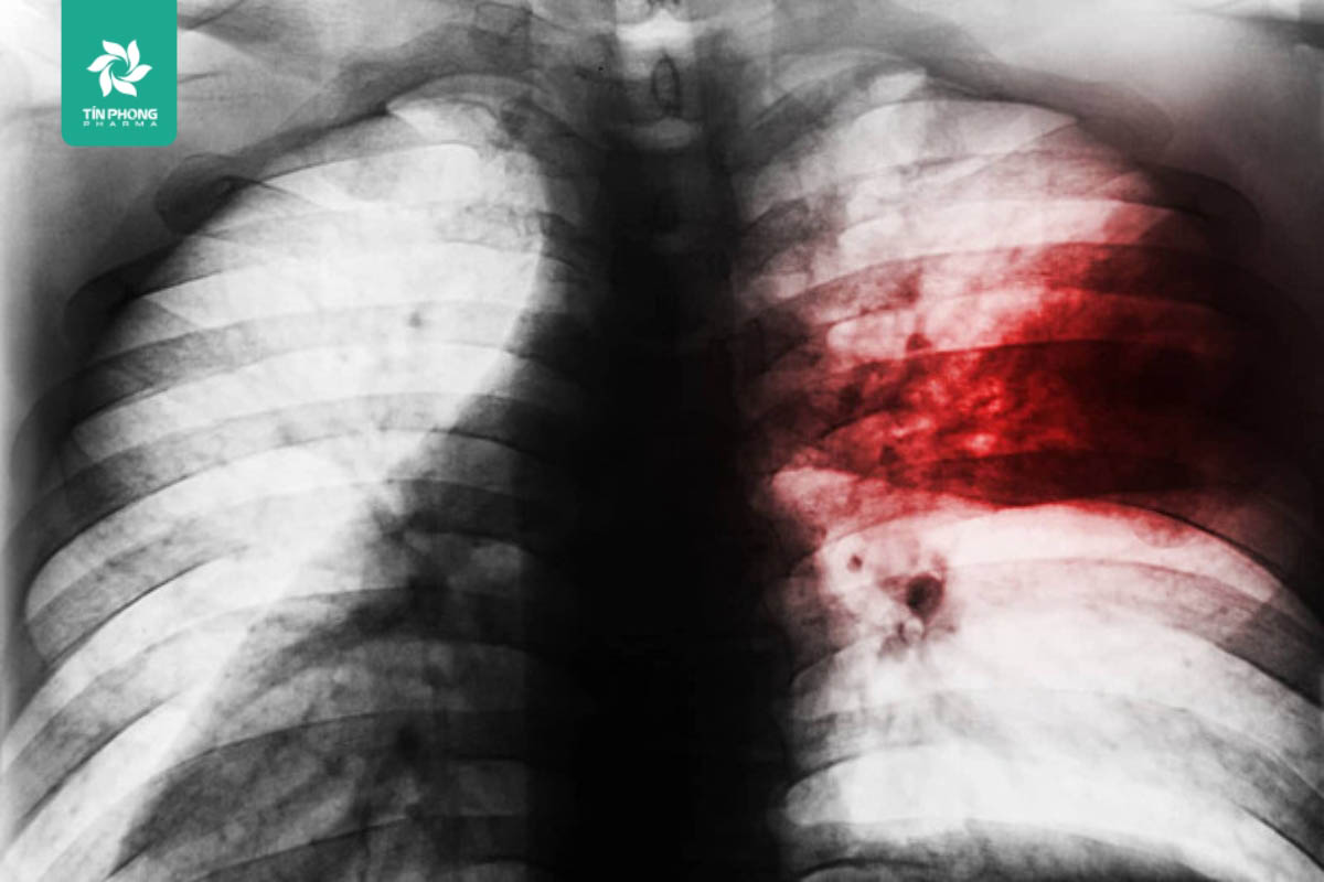 Viêm phổi thùy: Bệnh lý phổi nghiêm trọng, bạn cần hiểu rõ