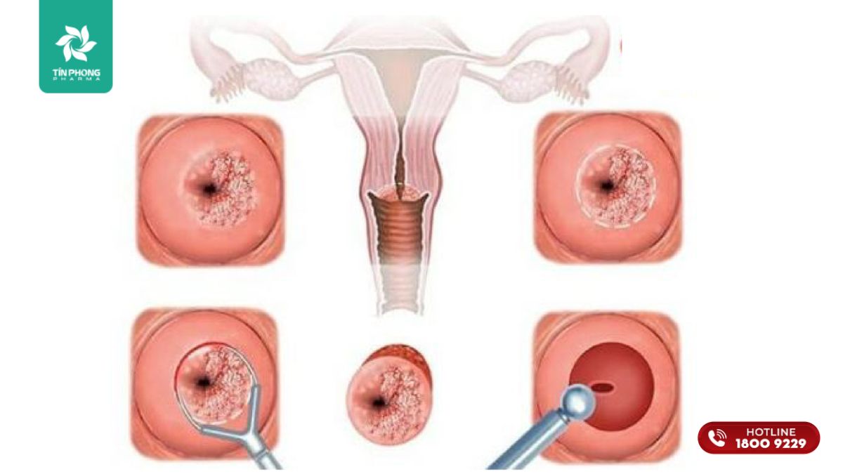 Viêm cổ tử cung là gì?
