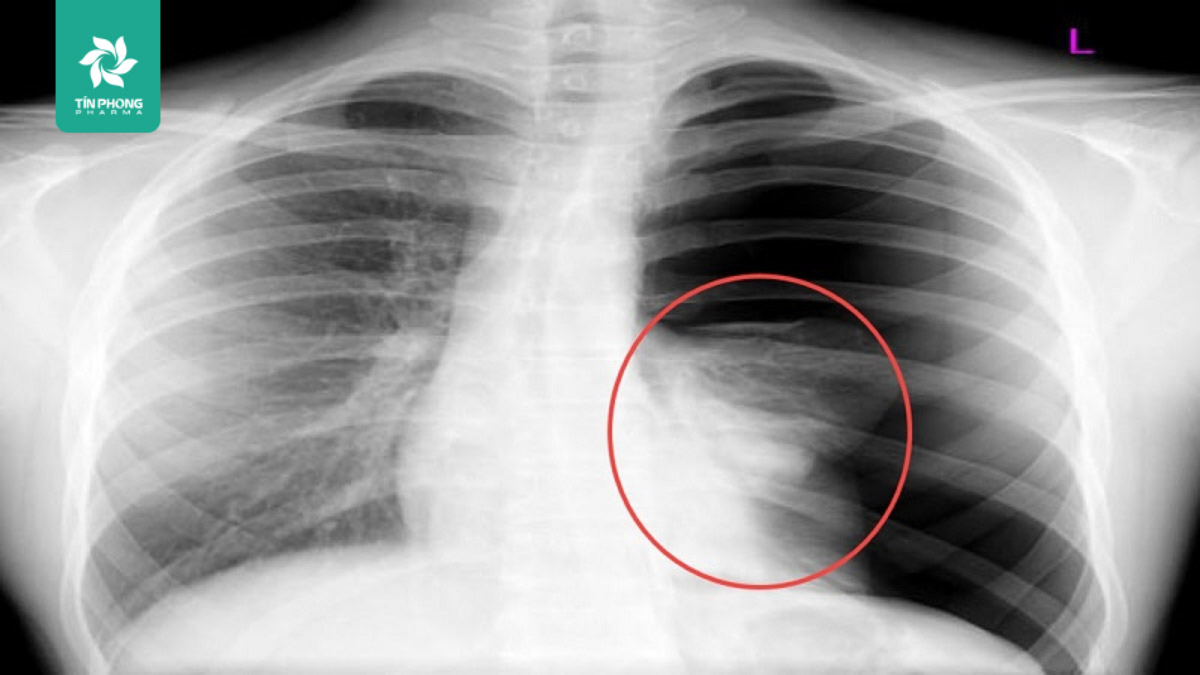 Cách xác định hội chứng ba giảm trong tràn dịch màng phổi 