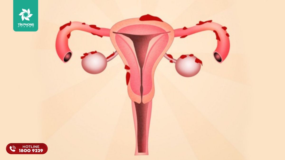 Lạc nội mạc tử cung là gì?