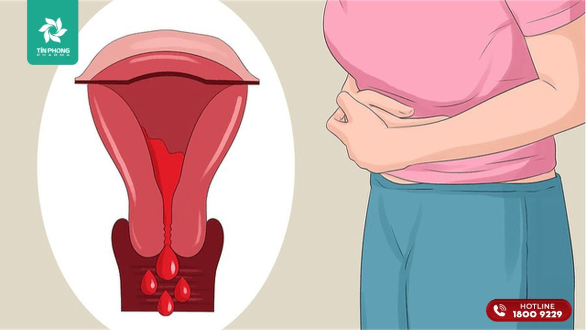 Trào ngược kinh nguyệt là nguyên nhân phổ biến nhất gây lạc nội mạc tử cung
