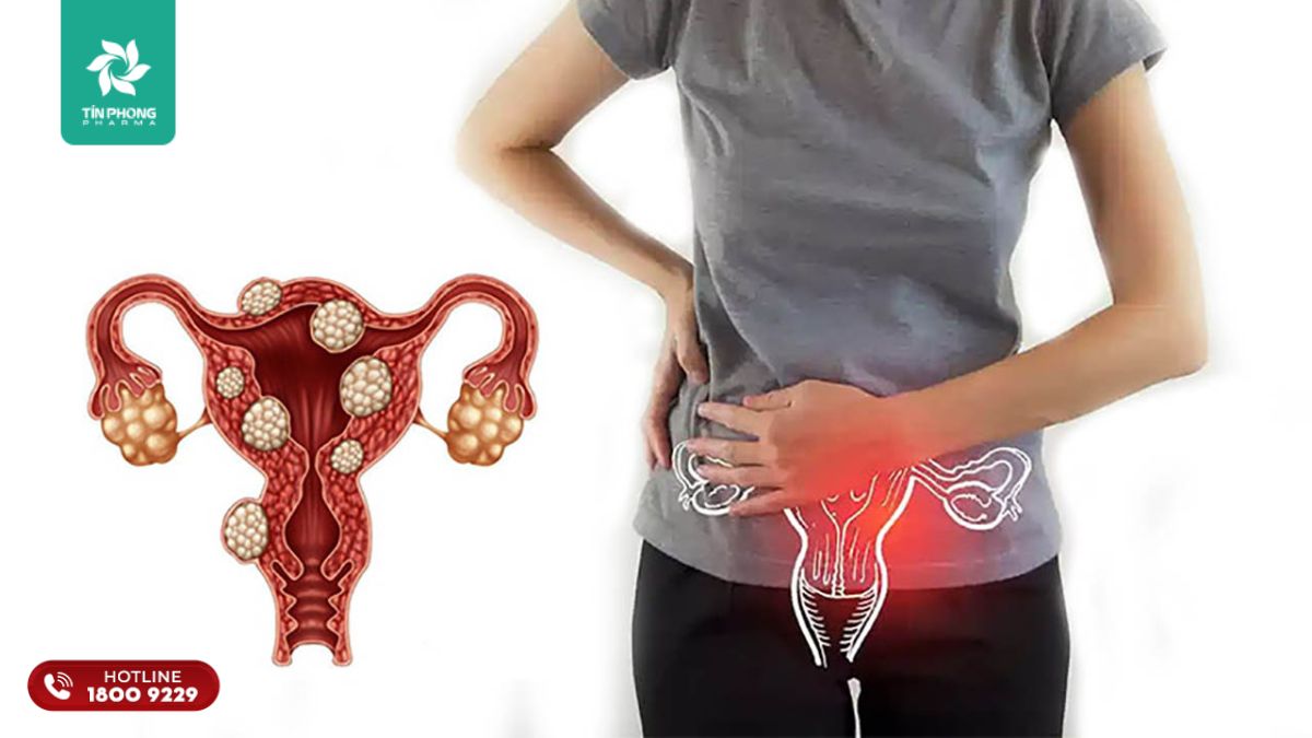U xơ tử cung gây đau bụng đau lưng